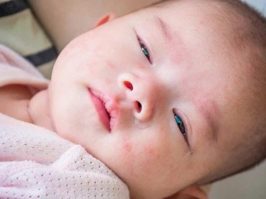 Trẻ Sơ Sinh Bị Sốt Co Giật g