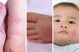 Trẻ Sơ Sinh Bị Chàm Sữa