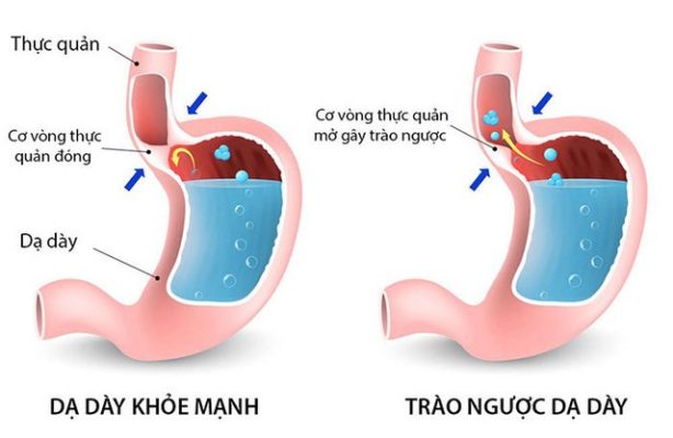 Trẻ Sơ Sinh Thở Khò Khè w